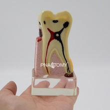 Load image into Gallery viewer, Enlarged Diseased Teeth Model Saprodontia Decayed Tooth Dental Nerve Oral Anatomical Model Educational Equipment Teaching Tool
