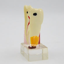 Load image into Gallery viewer, Enlarged Diseased Teeth Model Saprodontia Decayed Tooth Dental Nerve Oral Anatomical Model Educational Equipment Teaching Tool
