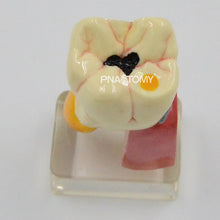 Load image into Gallery viewer, Enlarged Diseased Teeth Model Saprodontia Decayed Tooth Dental Nerve Oral Anatomical Model Educational Equipment Teaching Tool
