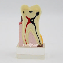 Load image into Gallery viewer, Enlarged Diseased Teeth Model Saprodontia Decayed Tooth Dental Nerve Oral Anatomical Model Educational Equipment Teaching Tool
