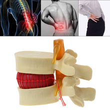 Load image into Gallery viewer, Medical props model Free postage Anatomical Spine Lumbar Disc Herniation Anatomy Medical Teaching Tool
