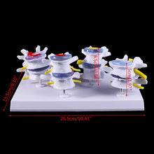 Load image into Gallery viewer, Medical props model 1 Set Human Lumbar Lesion Spine Statue Display Model Medical Teaching Learning Tool
