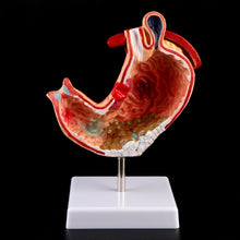 Load image into Gallery viewer, Human Anatomical Anatomy Stomach Medical Model Gastric Pathology Gastritis Ulcer Medical Teaching Learning Tool
