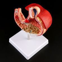 Load image into Gallery viewer, Human Anatomical Anatomy Stomach Medical Model Gastric Pathology Gastritis Ulcer Medical Teaching Learning Tool
