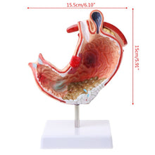Load image into Gallery viewer, Human Anatomical Anatomy Stomach Model Gastric Pathology Gastritis Ulcer Teaching Learning Tool
