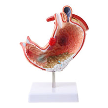 Load image into Gallery viewer, Human Anatomical Anatomy Stomach Model Gastric Pathology Gastritis Ulcer Teaching Learning Tool
