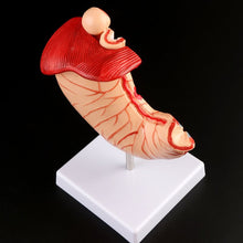 Load image into Gallery viewer, Human Anatomical Anatomy Stomach Model Gastric Pathology Gastritis Ulcer Teaching Learning Tool

