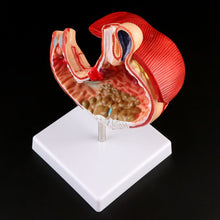 Load image into Gallery viewer, Human Anatomical Anatomy Stomach Model Gastric Pathology Gastritis Ulcer Teaching Learning Tool
