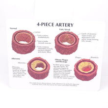 Load image into Gallery viewer, Human Atherosclerosis Model Thrombosis Model Artery Model Thrombosis Evolution Anatomy Medical Teaching Tool

