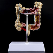 Load image into Gallery viewer, Human Colorectal Lesion Model Pathological Anatomy Colon Diseases Intestine Medical Teaching Learning Tool
