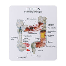 Load image into Gallery viewer, Human Colorectal Lesion Model Pathological Anatomy Colon Diseases Intestine Medical Teaching Learning Tool
