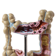 Load image into Gallery viewer, Human Colorectal Lesion Model Pathological Anatomy Colon Diseases Intestine Medical Teaching Learning Tool

