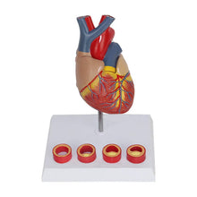 Load image into Gallery viewer, Human Heart Anatomy Model with 4 Stage Thrombus Medical Science Teaching Resources Drop Shipping

