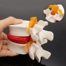 Load image into Gallery viewer, Human anatomy skeleton Spine Lumbar Disc Herniation Teaching Model brain skull traumatic pistol school supplies medical instrume
