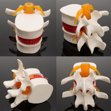 Load image into Gallery viewer, Human anatomy skeleton Spine Lumbar Disc Herniation Teaching Model brain skull traumatic pistol school supplies medical instrume
