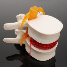 Load image into Gallery viewer, Human anatomy skeleton Spine Lumbar Disc Herniation Teaching Model brain skull traumatic pistol school supplies medical instrume
