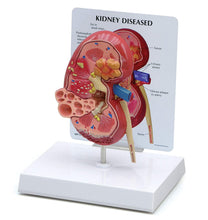 Load image into Gallery viewer, Kidney Pathologies Model Human Body Anatomy Replica of Diseased Kidney for Doctors Office Educational Tool GPI Anatomicals

