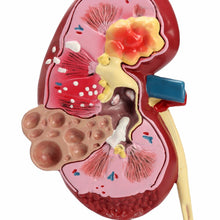 Load image into Gallery viewer, Kidney Pathology Model Human Anatomy Pathological Kidney Model for Physician's Office Educational Tool GPI Anatomy
