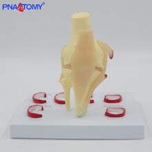 Load image into Gallery viewer, Life Size Knee Joint Model with Ligaments Shows Meniscus Tears Medical Teaching Tool Anatomical Model Skeleton Anatomy Toy
