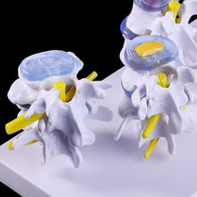 Load image into Gallery viewer, Medical props model 1 Set Human Lumbar Lesion Spine Statue Display Model Medical Teaching Learning Tool
