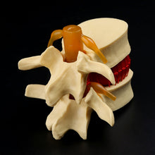 Load image into Gallery viewer, Medical props model Free postage Anatomical Spine Lumbar Disc Herniation Anatomy Medical Teaching Tool
