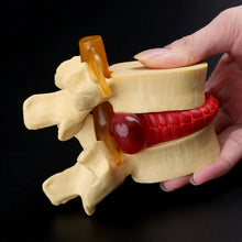 Load image into Gallery viewer, Medical props model Free postage Anatomical Spine Lumbar Disc Herniation Anatomy Medical Teaching Tool
