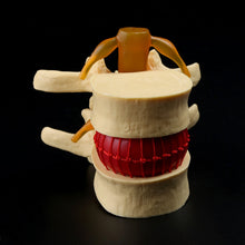 Load image into Gallery viewer, Medical props model Free postage Anatomical Spine Lumbar Disc Herniation Anatomy Medical Teaching Tool
