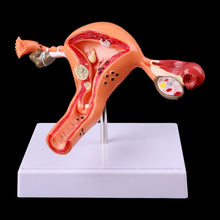 Load image into Gallery viewer, Medical props model Free postage Pathological Uterus Ovary Anatomical Model Anatomy Cross Section Study Tool
