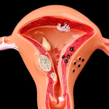 Load image into Gallery viewer, Medical props model Free postage Pathological Uterus Ovary Anatomical Model Anatomy Cross Section Study Tool
