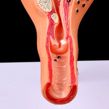 Load image into Gallery viewer, Medical props model Free postage Pathological Uterus Ovary Anatomical Model Anatomy Cross Section Study Tool

