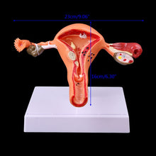 Load image into Gallery viewer, Medical props model Free postage Pathological Uterus Ovary Anatomical Model Anatomy Cross Section Study Tool
