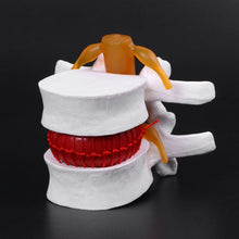 Load image into Gallery viewer, Medical props model Human Anatomical Lumbar Disc Herniation Model Medical Learn Aid Anatomy Instrume
