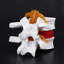 Load image into Gallery viewer, Medical props model Human Anatomical Lumbar Disc Herniation Model Medical Learn Aid Anatomy Instrume
