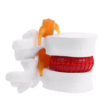 Load image into Gallery viewer, Medical props model Human Anatomical Lumbar Disc Herniation Model Medical Learn Aid Anatomy Instrume
