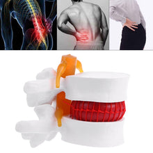 Load image into Gallery viewer, Medical props model Human Anatomical Lumbar Disc Herniation Model Medical Learn Aid Anatomy Instrume
