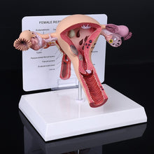 Load image into Gallery viewer, Medical props model Human Female Pathological Uterus Ovary Model Anatomical Disease Pathology Medical Lesion ForBiology Teaching
