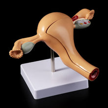 Load image into Gallery viewer, Medical props model Human Pathological Uterus Ovary Model Anatomical Anatomy Disease Pathology Medical Lesion For Teaching
