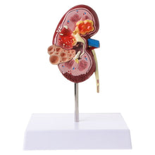 Load image into Gallery viewer, Medical props model Life Size Human Kidney Diseased Model Anatomical Anatomy Diseased Pathological Stone Organ Teaching Supplies
