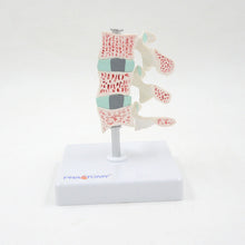 Load image into Gallery viewer, Human Body Model Bone Osteoporosis Lesion Model Spine Cervical Vertebra Displane Model Joint Model Bone Model
