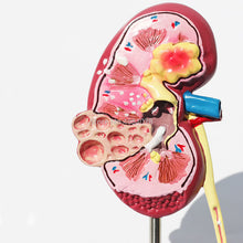 Load image into Gallery viewer, Organ Medical Kidney Anatomical Model Lesion Kidney Model Human Anatomy Teaching Supplies
