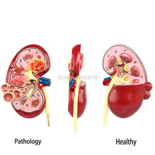 Load image into Gallery viewer, Organ Medical Kidney Anatomical Model Lesion Kidney Model Human Anatomy Teaching Supplies
