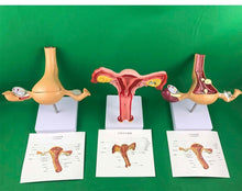 Load image into Gallery viewer, Ovary and uterus disease Dissection model Pathology Female uterus model teaching human medical aids anatomy lesion uterus
