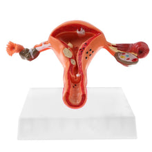 Load image into Gallery viewer, Pathological Uterus and Ovary Anatomical Model - Human Female Medical Anatomy
