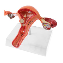 Load image into Gallery viewer, Pathological Uterus and Ovary Anatomical Model - Human Female Medical Anatomy
