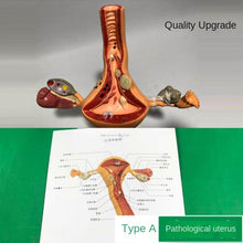 Load image into Gallery viewer, Ovary and uterus disease Dissection model Pathology Female uterus model teaching human medical aids anatomy lesion uterus
