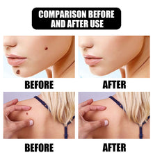 Load image into Gallery viewer, Mole Removal Wart Essence Skin Removal Facial Armpit Flesh Bump Repair Cleaning Care
